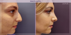 Before and after image of a rhinoplasty procedure.